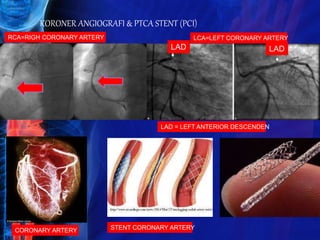KORONER ANGIOGRAFI & PTCA STENT (PCI)
RCA=RIGH CORONARY ARTERY LCA=LEFT CORONARY ARTERY
CORONARY ARTERY STENT CORONARY ARTERY
LAD LAD
LAD = LEFT ANTERIOR DESCENDEN
 