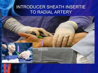 INTRODUCER SHEATH INSERTIE
TO RADIAL ARTERY
SHEATH
 