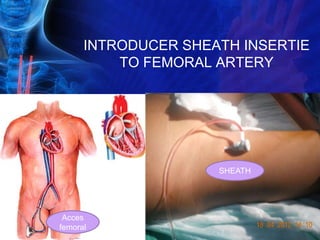 INTRODUCER SHEATH INSERTIE
TO FEMORAL ARTERY
SHEATH
Acces
femoral
 