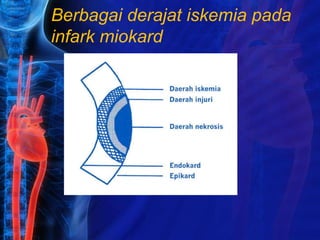 Berbagai derajat iskemia pada
infark miokard
 