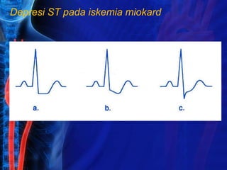Depresi ST pada iskemia miokard
 