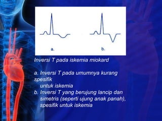 Inversi T pada iskemia miokard
a. Inversi T pada umumnya kurang
spesifik
untuk iskemia
b. Inversi T yang berujung lancip dan
simetris (seperti ujung anak panah),
spesifik untuk iskemia
 