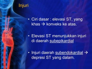 Injuri
• Ciri dasar : elevasi ST, yang
khas  konveks ke atas.
• Elevasi ST menunjukkan injuri
di daerah subepikardial
• Injuri daerah subendokardial 
depresi ST yang dalam.
 