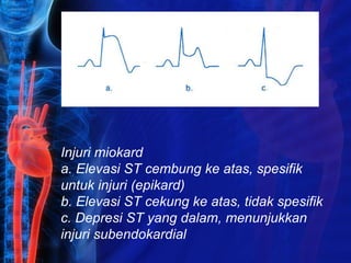Injuri miokard
a. Elevasi ST cembung ke atas, spesifik
untuk injuri (epikard)
b. Elevasi ST cekung ke atas, tidak spesifik
c. Depresi ST yang dalam, menunjukkan
injuri subendokardial
 