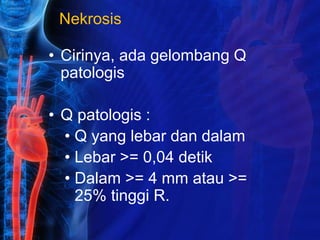 Nekrosis
• Cirinya, ada gelombang Q
patologis
• Q patologis :
• Q yang lebar dan dalam
• Lebar >= 0,04 detik
• Dalam >= 4 mm atau >=
25% tinggi R.
 