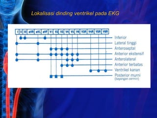 Lokalisasi dinding ventrikel pada EKG
 