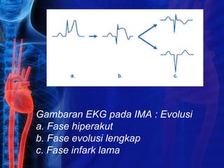 Gambaran EKG pada IMA : Evolusi
a. Fase hiperakut
b. Fase evolusi lengkap
c. Fase infark lama
 