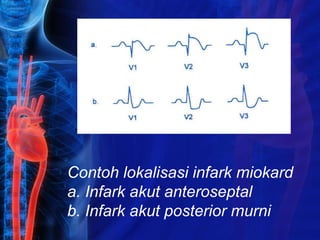 Contoh lokalisasi infark miokard
a. Infark akut anteroseptal
b. Infark akut posterior murni
 