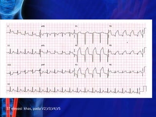 ST elevasi khas, pada V2,V3,V4,V5
 