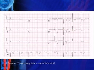 ST depresi, T inversi yang dalam, pada V2,V3<V4,V5
 