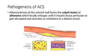 ACS –Pathogenesis, Presentation and Treatment.pptx