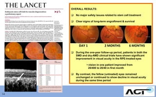 OVERALL RESULTS:
 No major safety issues related to stem cell treatment
 Clear signs of long-term engraftment & survival

DAY 1

2 MONTHS

6 MONTHS

 During the one-year follow-up period, patients in both the
SMD and dry-AMD clinical trials have shown significant
improvement in visual acuity in the RPE-treated eyes
• vision in one patient improved from
20/400 to 20/40 in first month
 By contrast, the fellow (untreated) eyes remained
unchanged or continued to show decline in visual acuity
during the same time period

14

 