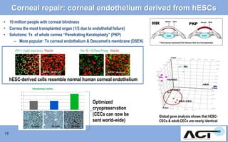 Corneal repair: corneal endothelium derived from hESCs
• 10 million people with corneal blindness
• Cornea the most transplanted organ (1/3 due to endothelial failure)
• Solutions: Tx of whole cornea “Penetrating Keratoplasty” (PKP)
– More popular: Tx corneal endothelium & Descemet’s membrane (DSEK)

hESC-derived cells resemble normal human corneal endothelium

Optimized
cryopreservation
(CECs can now be
sent world-wide)
19

Global gene analysis shows that hESCCECs & adult-CECs are nearly identical

 