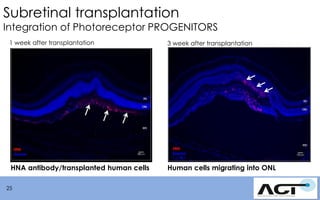 Subretinal transplantation

Integration of Photoreceptor PROGENITORS
1 week after transplantation

3 week after transplantation

HNA antibody/transplanted human cells

Human cells migrating into ONL

25

 