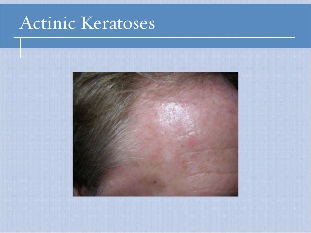 Actinic Keratoses Pre malignant Skin Tumors Actinic Keratoses Pre malignant Skin Tumors