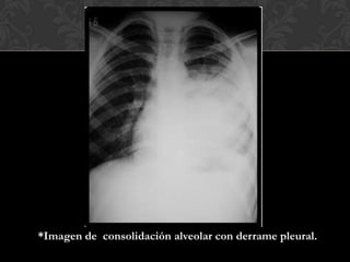 *Imagen de consolidación alveolar con derrame pleural.
 