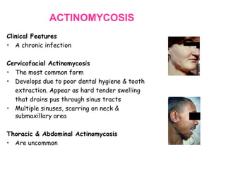ACTINOMYCOSIS
Clinical Features
• A chronic infection
Cervicofacial Actinomycosis
• The most common form
• Develops due to poor dental hygiene & tooth
extraction. Appear as hard tender swelling
that drains pus through sinus tracts
• Multiple sinuses, scarring on neck &
submaxillary area
Thoracic & Abdominal Actinomycosis
• Are uncommon

 