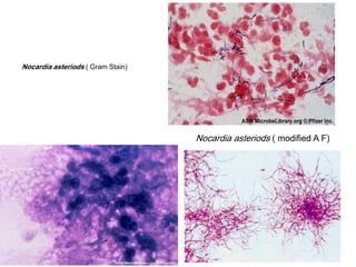 Nocardia asteriods ( Gram Stain)

Nocardia asteriods ( modified A F)

 