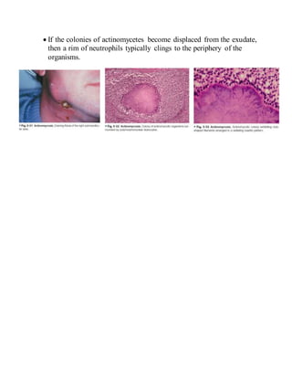  If the colonies of actinomycetes become displaced from the exudate,
then a rim of neutrophils typically clings to the periphery of the
organisms.
 