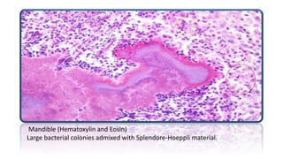 Mandible (Hematoxylin and Eosin)
Large bacterial colonies admixed with Splendore-Hoeppli material.
 