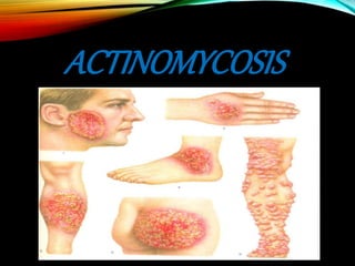 ACTINOMYCOSIS
 
