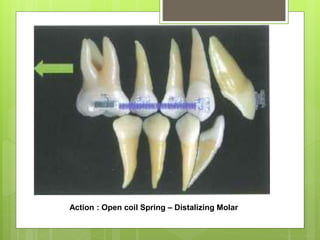 Action and reaction in orthodontics | PPTX
