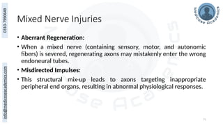 71
Mixed Nerve Injuries
• Aberrant Regeneration:
• When a mixed nerve (containing sensory, motor, and autonomic
fibers) is severed, regenerating axons may mistakenly enter the wrong
endoneural tubes.
• Misdirected Impulses:
• This structural mix-up leads to axons targeting inappropriate
peripheral end organs, resulting in abnormal physiological responses.
 