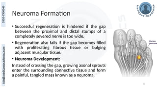 73
Neuroma Formation
• Successful regeneration is hindered if the gap
between the proximal and distal stumps of a
completely severed nerve is too wide.
• Regeneration also fails if the gap becomes filled
with proliferating fibrous tissue or bulging
adjacent muscular tissue.
• Neuroma Development:
Instead of crossing the gap, growing axonal sprouts
enter the surrounding connective tissue and form
a painful, tangled mass known as a neuroma.
 