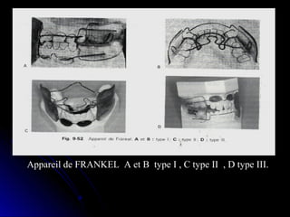 Appareil de FRANKEL A et B type I , C type II , D type III.

 