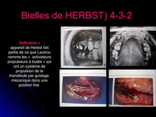 Bielles de HERBST( 4-3-2
Définition :
appareil de Herbst fait
partie de ce que Lautrou
nomme les « activateurs
propulseurs à butée » qui
ont un système de
propulsion de la
mandibule par guidage
mécanique dans une
position fixe

 