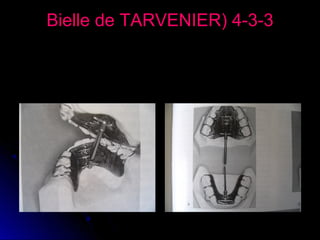 Bielle de TARVENIER( 4-3-3
Correspond au même principe avec une plaque
maxillaire et une plaque mandibulaire reliée par
une seule bielle centrale.

 