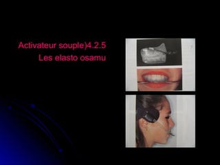 Activateur souple(4.2.5
Les elasto osamu

 