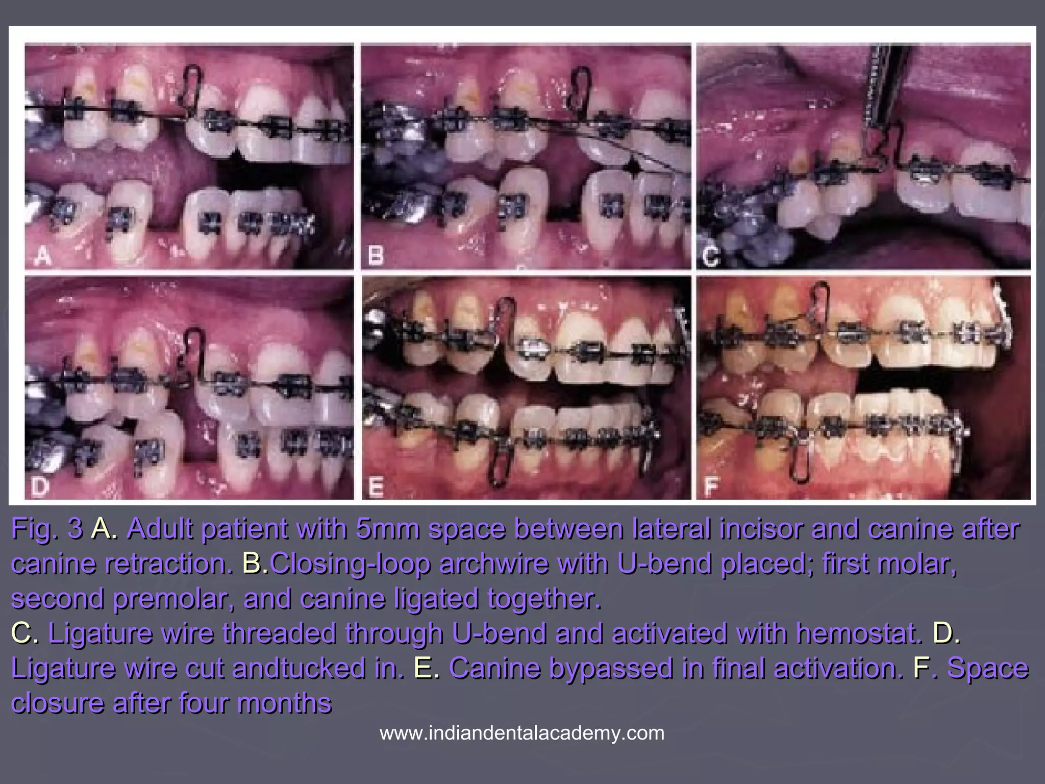Fig. 3Fig. 3 A.A. Adult patient with 5mm space between lateral incisor and canine afterAdult patient with 5mm space between lateral incisor and canine after
canine retraction.canine retraction. B.B.Closing-loop archwire with U-bend placed; first molar,Closing-loop archwire with U-bend placed; first molar,
second premolar, and canine ligated together.second premolar, and canine ligated together.
C.C. Ligature wire threaded through U-bend and activated with hemostat.Ligature wire threaded through U-bend and activated with hemostat. D.D.
Ligature wire cut andtucked in.Ligature wire cut andtucked in. E.E. Canine bypassed in final activation.Canine bypassed in final activation. FF. Space. Space
closure after four monthsclosure after four months
www.indiandentalacademy.com
 