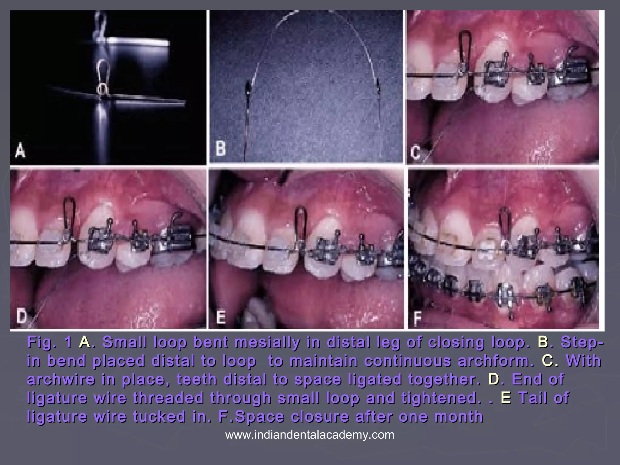 Fig. 1Fig. 1 AA. Small loop bent mesially in distal leg of closing loop.. Small loop bent mesially in distal leg of closing loop. BB. Step-. Step-
in bend placed distal to loop to maintain continuous archform.in bend placed distal to loop to maintain continuous archform. C.C. WithWith
archwire in place, teeth distal to space ligated together.archwire in place, teeth distal to space ligated together. DD. End of. End of
ligature wire threaded through small loop and tightened. .ligature wire threaded through small loop and tightened. . EE Tail ofTail of
ligature wire tucked in. F.Space closure after one monthligature wire tucked in. F.Space closure after one month
www.indiandentalacademy.com
 