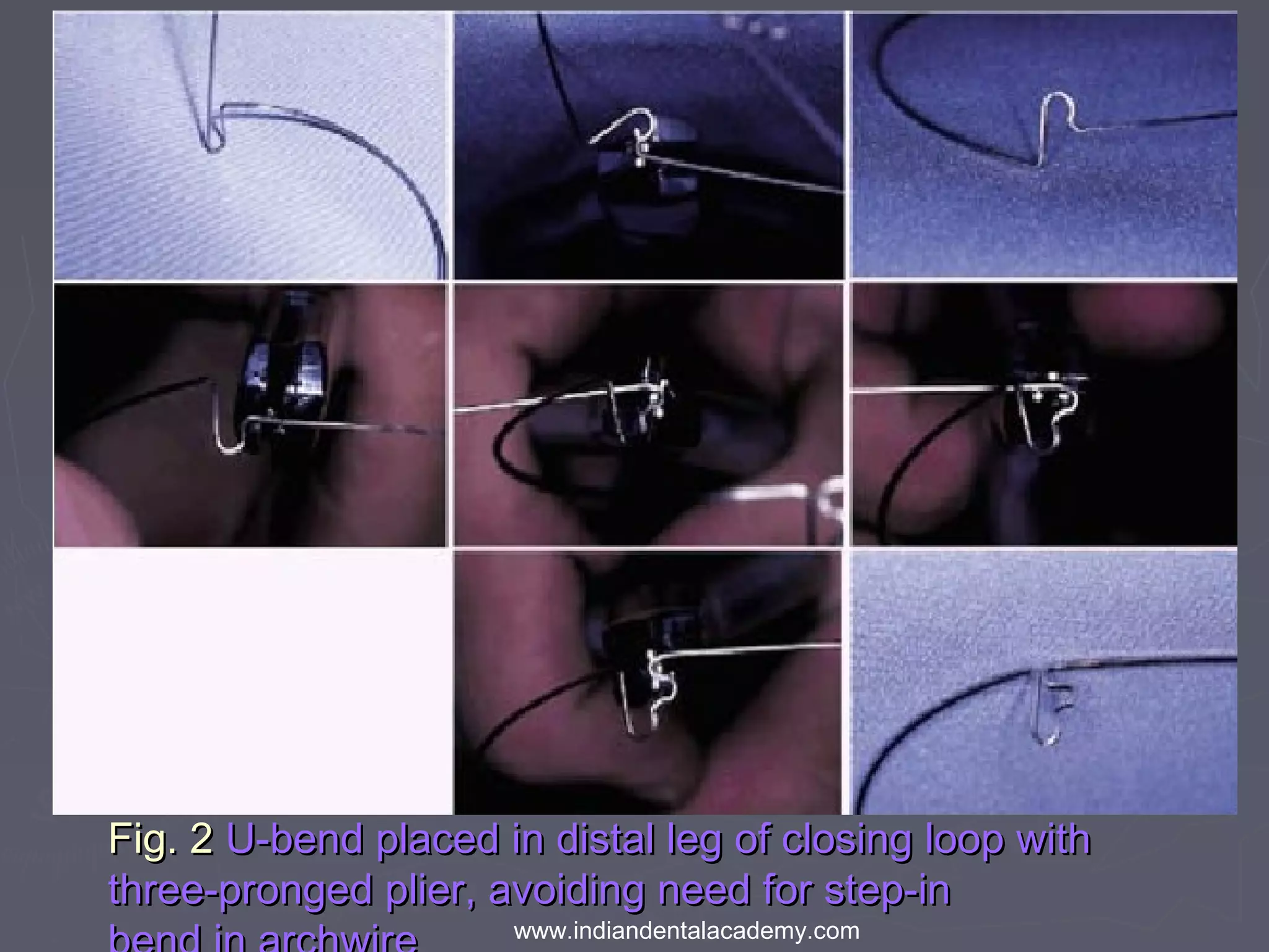 Fig. 2Fig. 2 U-bend placed in distal leg of closing loop withU-bend placed in distal leg of closing loop with
three-pronged plier, avoiding need for step-inthree-pronged plier, avoiding need for step-in
www.indiandentalacademy.com
 