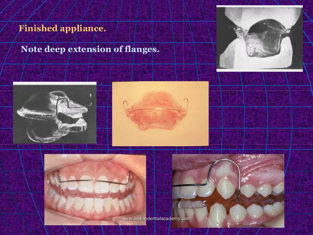 Activator /certified fixed orthodontic courses by Indian dental acade…