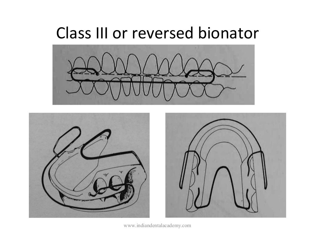 Activator , functional appliance in orthodontics / orthodontics train…