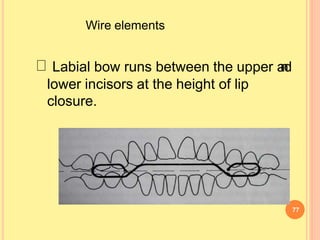 Wire elements
Labial bow runs between the upper a
n
d
lower incisors at the height of lip
closure.
77
 