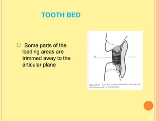 TOOTH BED
86
Some parts of the
loading areas are
trimmed away to the
articular plane
 