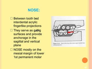 NOSE:
87
Between tooth bed
interdental acrylic
fingerlike projections
They serve as guiding
surfaces and provide
anchorage in the
sagittal and vertical
plane
NOSE mostly on the
mesial margin of lower
1st permanent molar
 