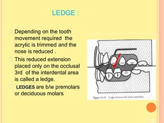 LEDGE :
88
Depending on the tooth
movement required the
acrylic is trimmed and the
nose is reduced .
This reduced extension
placed only on the occlusal
3rd of the interdental area
is called a ledge.
LEDGES are b/w premolars
or deciduous molars
 