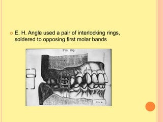  E. H. Angle used a pair of interlocking rings,
soldered to opposing first molar bands
 