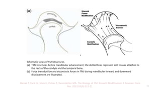 Schematic views of TMJ structures.
(a) TMJ structures before mandibular advancement; the dotted lines represent soft tissues attached to
the neck of the condyle and the temporal bone.
(b) Force transduction and viscoelastic forces in TMJ during mandibular forward and downward
displacement are illustrated.
Owtad P, Park JH, Shen G, Potres Z, Darendeliler MA. The Biology of TMJ Growth Modification: A Review J Dent
Res. 2013;92(4):315-21. 11
 