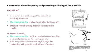 Construction bite with opening and posterior positioning of the mandible
CLASS III MO
• Goal is posterior positioning of the mandible or
maxillary protraction.
• The construction bite is taken by retruding the lower jaw.
• Extent of vertical opening depends on the retrusion
possible.
In Pseudo Class lll,
• The construction bite: vertical opening is enough to clear
the incisal guidance for the construction bite.
• Here it is possible to achieve an edge-to-edge bite
relationship with posterior teethstill out of contact.
54
 