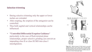 Selective trimming
• During selective trimming only the upper or lower
molars are extruded.
• After erupting, the eruption of the antagonist can be
controlled.
• Thus both sagittal and vertical relationships can be
influenced.
• "Controlled Differential Eruption Guidance"
particularly in the case of flush terminal plane
relationships, proper selective grinding can convert an
impending class II or class III MO into class I
interdigitation.
59
 