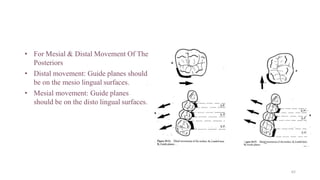 • For Mesial & Distal Movement Of The
Posteriors
• Distal movement: Guide planes should
be on the mesio lingual surfaces.
• Mesial movement: Guide planes
should be on the disto lingual surfaces.
62
 