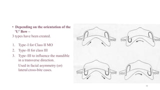 • Depending on the orientation of the
'U' Bow –
3 types have been created.
1. Type–I for Class II MO
2. Type–II for class III
3. Type–III to influence the mandible
in a transverse direction.
Used in facial asymmetry (or)
lateral cross-bite cases.
78
 