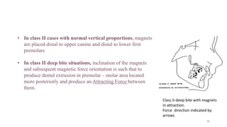 • In class II cases with normal vertical proportions, magnets
are placed distal to upper canine and distal to lower first
premolars
• In class II deep bite situations, inclination of the magnets
and subsequent magnetic force orientation is such that to
produce dental extrusion in premolar – molar area located
more posteriorly and produce an Attracting Force between
them.
Class II-deep bite with magnets
in attraction.
Force direction indicated by
arrows
90
 