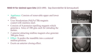 MAD IV for skeletal open bite (JCO 1995- Sep Darendeliler & Semayuksel)
• Appliance: Consists of removable upper and lower
plates.
• Uses Neodymium (Nd2Fe17B) magnets
coated with stainless steel.
• Consists of 4 posterior repelling magnets which
generate a force of 300 gms each for intruding the
molars.
• 2 anterior attracting midline magnets also generate
300 gms force.
• Effect: It guides the mandible into a centered
midline position.
• Exerts an anterior closing effect.
92
 