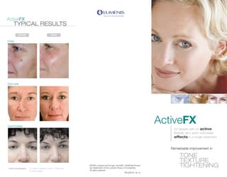 ActiveFX
     TYPICAL RESULTS
           BEFORE                                   AFTER


TONE




TEXTURE




                                                                                                                                    ActiveFX
                                                                                                                                                       ™




TIGHTENING
                                                                                                                                        for people with an active
                                                                                                                                        lifestyle who want noticeable
                                                                                                                                        effects in a single treatment


                                                                            